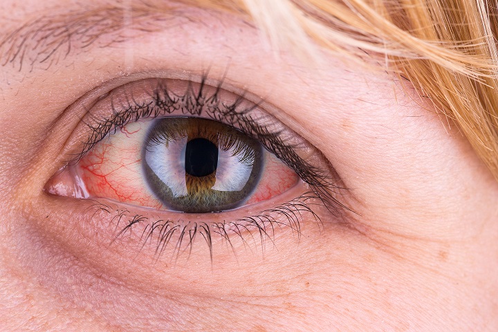 Olhos vermelhos ajudam a diagnosticar doenças
